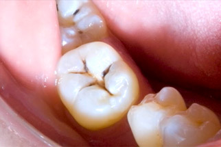 Composite Fillings - Vancouver Dentist