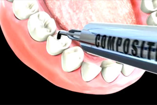 Composite Fillings - Vancouver Dentist