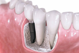 Implant Dentistry - Dr. Wayne Chou Vancouver