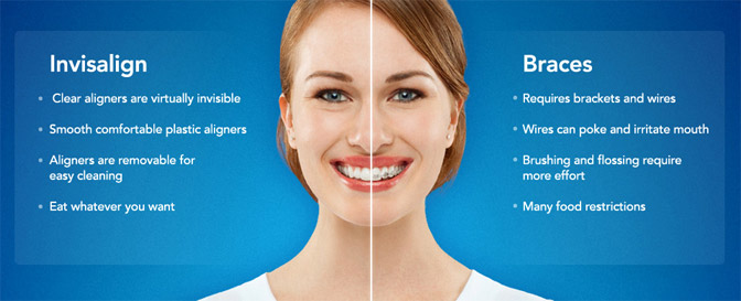 Invisible Braces - Dr. Wayne Chou Vancouver